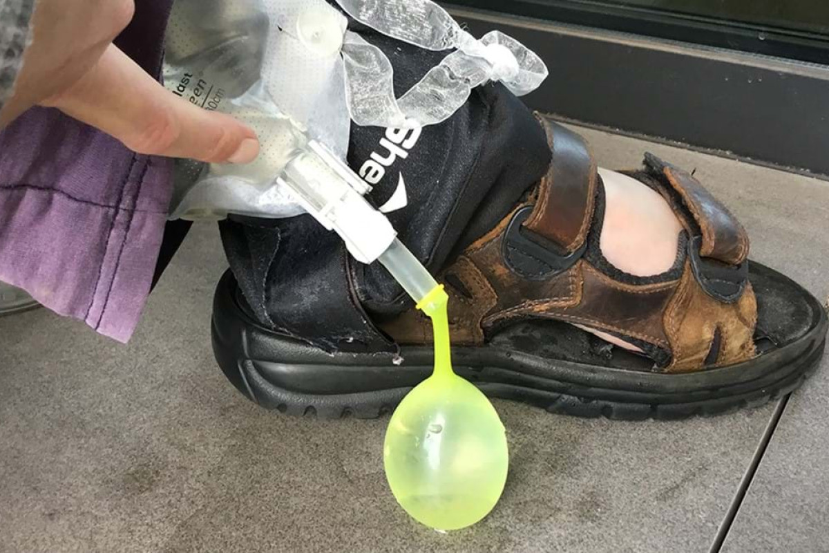 This is a close-up photo of me (Sam) releasing urine from my catheter into a yellow water balloon. I’m wearing blue pants faded to purple, a grey plaid shirt and brown leather sandals. My Dystonic hand is visible from the top left corner, pushing urine out of my catheter bag.